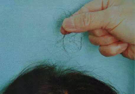 over 70% of post 90s suffer from hair loss