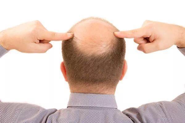 over 70% of post 90s suffer from hair loss